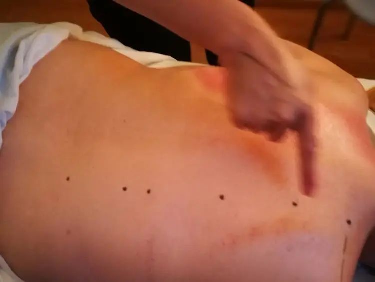 tuina-workshop-massage-markierungen