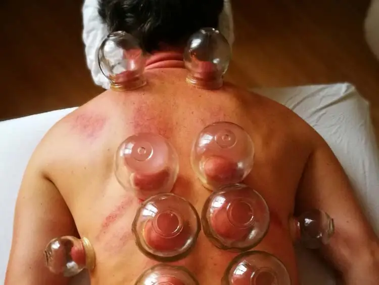 Tuina Paxis Workshop Schroepfen Nov `17