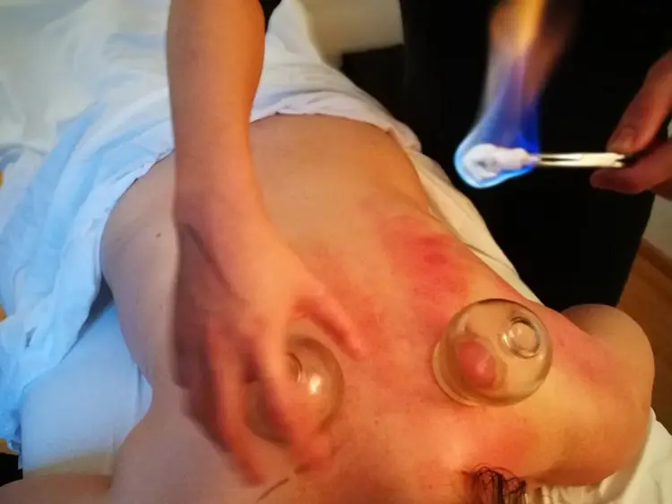 tuina-workshop-massage-schroepfen